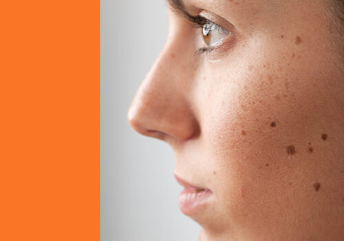 Faculdade Florence apoia o Dezembro Laranja e alerta para cuidados com a pele